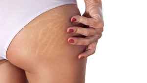 10 Solutions for Stretch Mark Removal